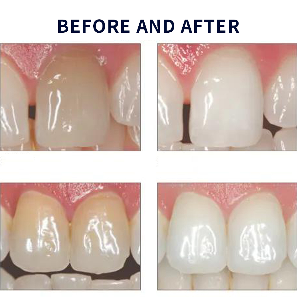 Opalescencia blanqueadora 20%  - Teeth Whitening Before And After reseña y precio